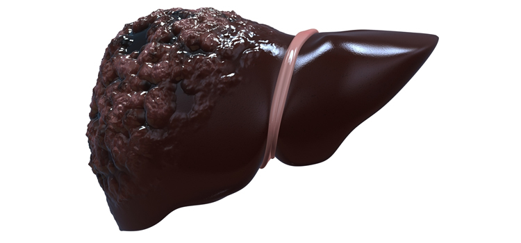 Liver_infected