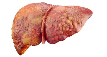 What’s the Biggest Cause of Fatty Liver Disease?