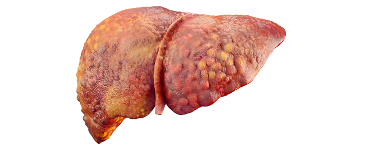 What’s the Biggest Cause of Fatty Liver Disease?