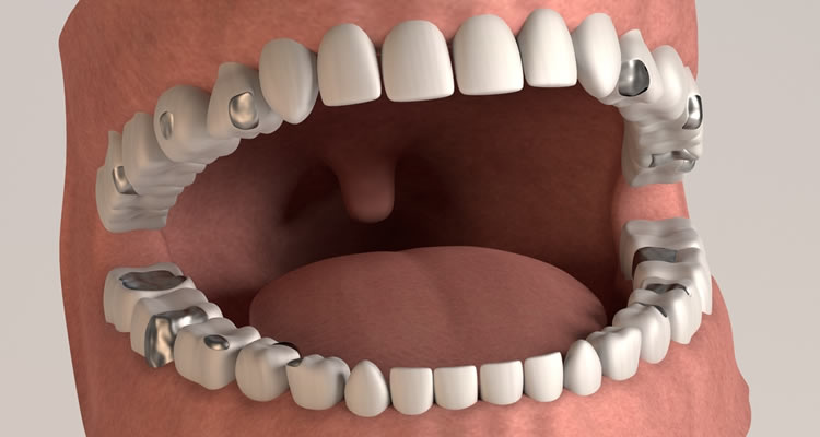Mercury tooth filling