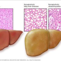 Diagnosis of Fatty Liver Disease