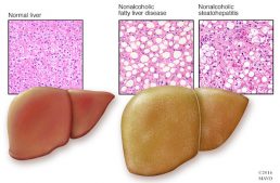 Diagnosis of Fatty Liver Disease