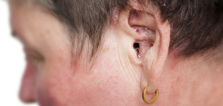 Psoriasis